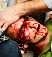 Demonstrator injured by tear gas canister in Nabi Saleh, December 2010